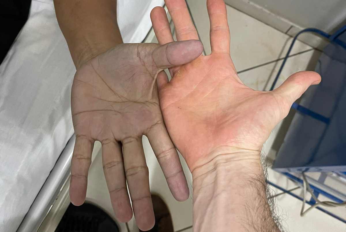 Il paziente dalle mani blu
