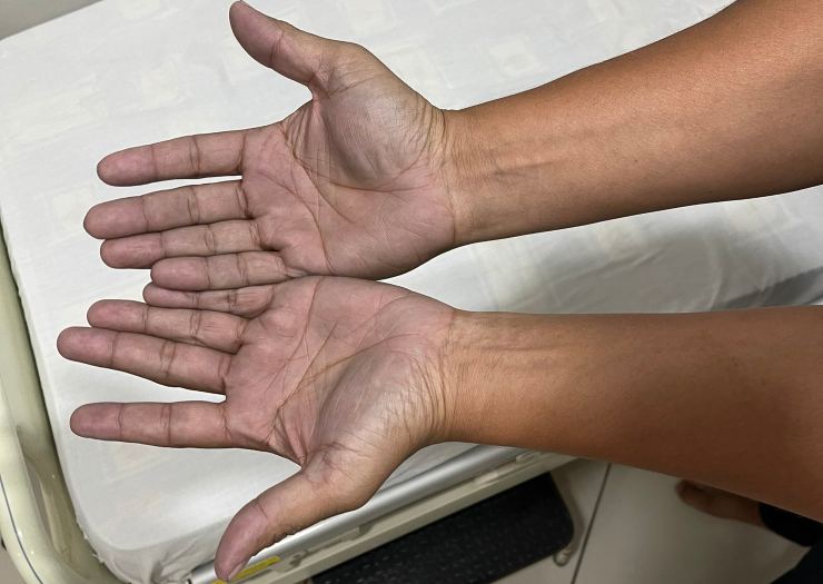 La diagnosi del dottore per le mani bluastre