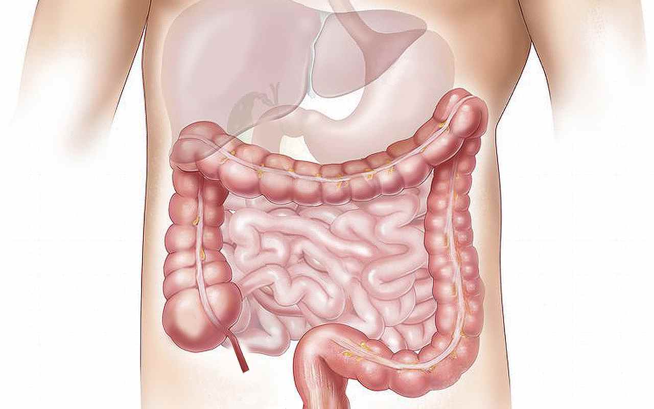 Tumore al colon