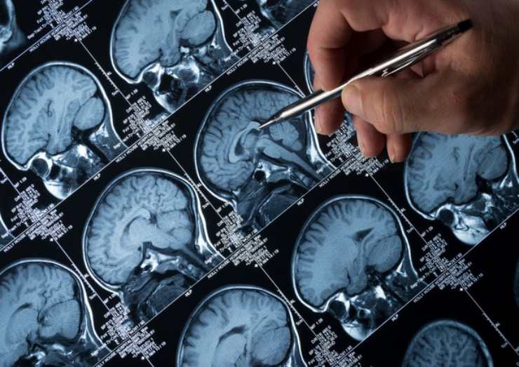 Scoperto un genere che potrebbe causare l'Alzheimer 