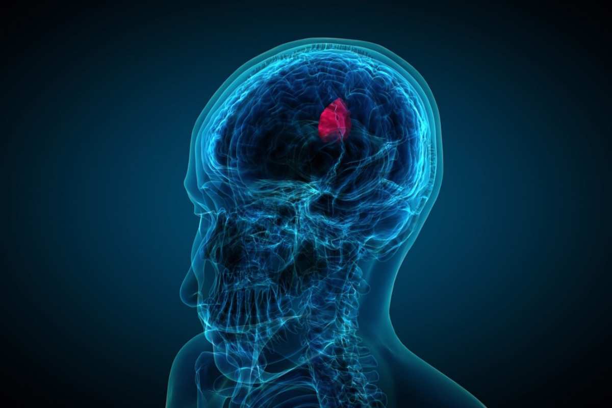 glioma tumore 