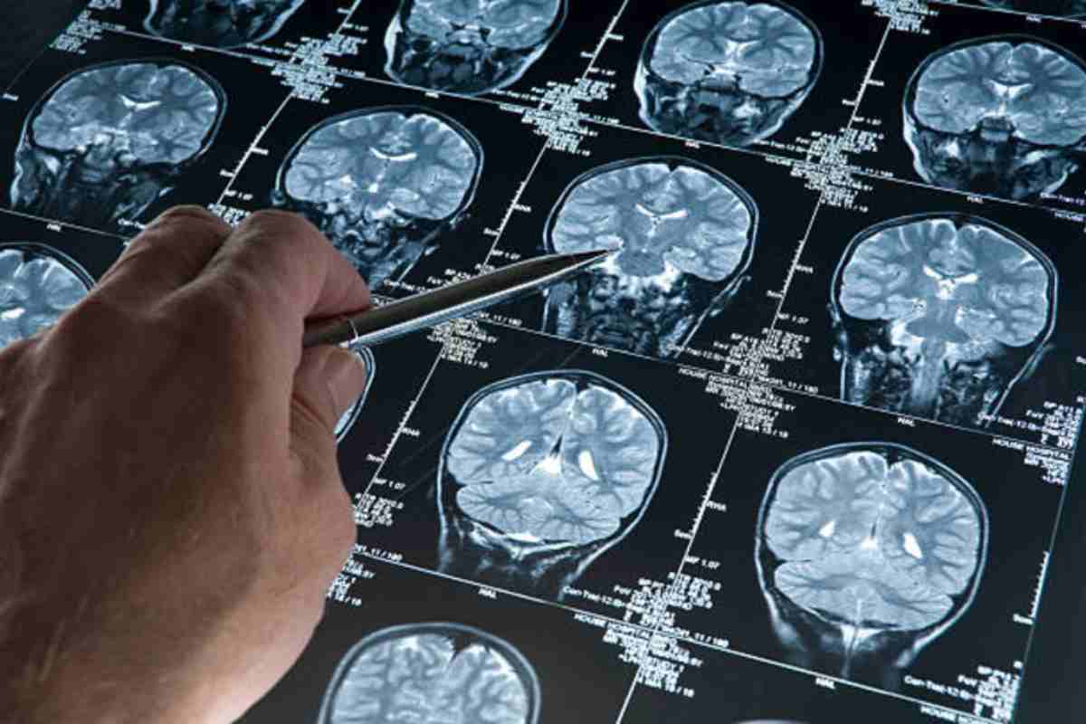 Lotta ai tumori: neurinoma asportato con robot