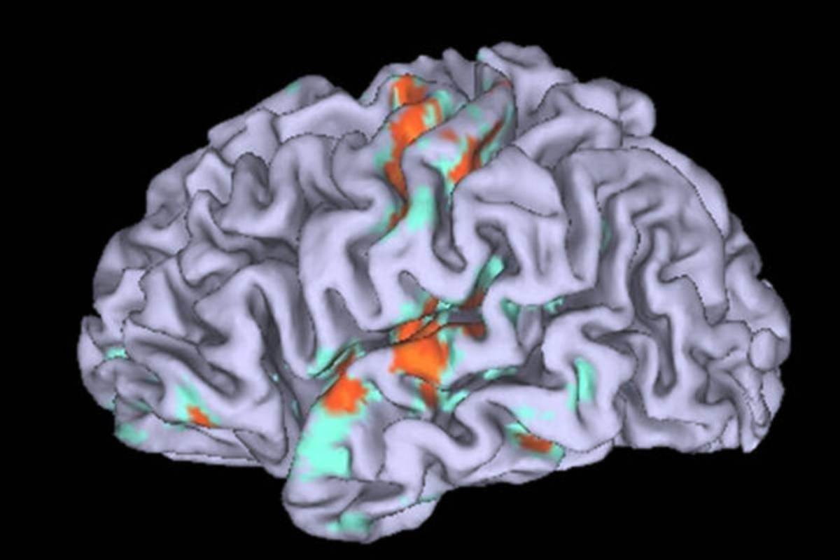 Neuralink paziente