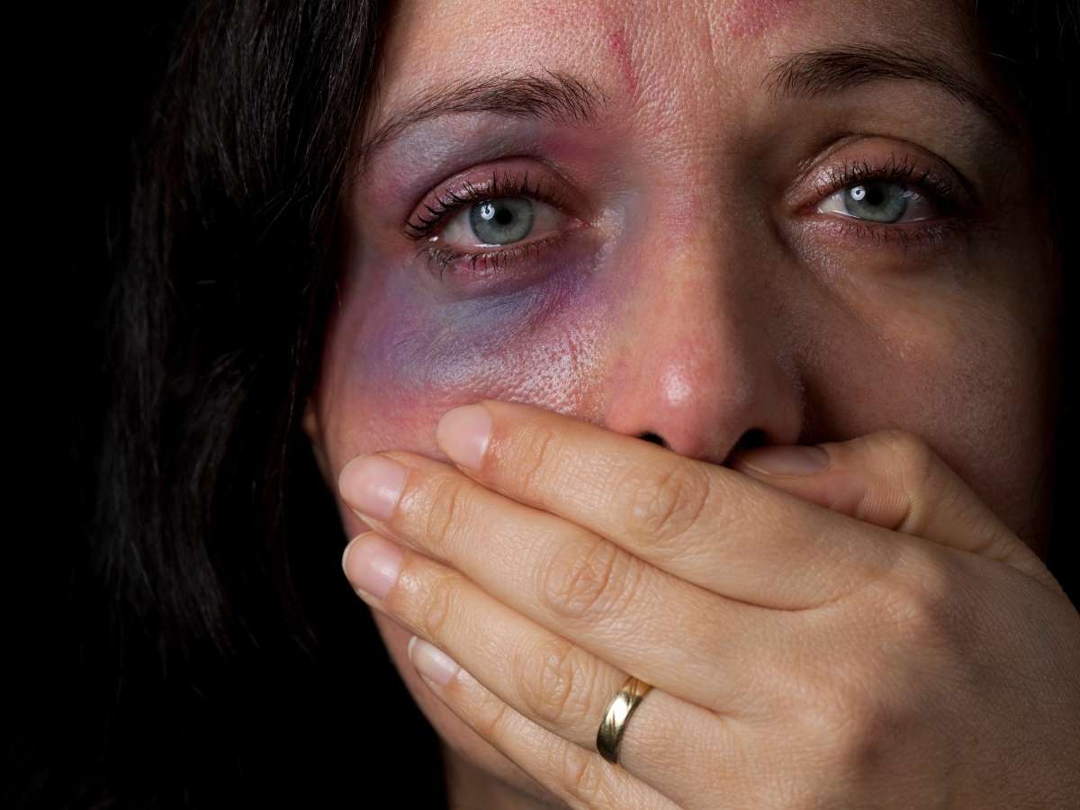 Una donna vittima di violenza con un livido all'occhio si copre la bocca con la mano sinistra sulla quale porta una fede