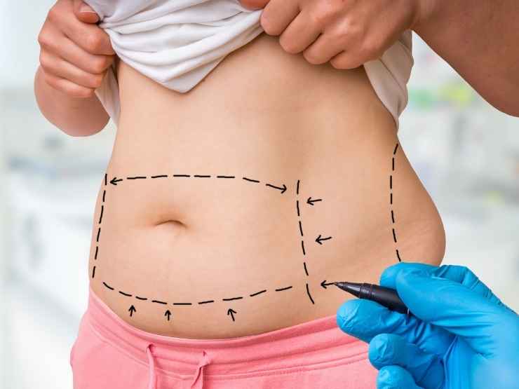 Intervento di liposuzione