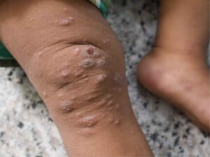 La malattia del vaiolo delle scimmie sulle gambe