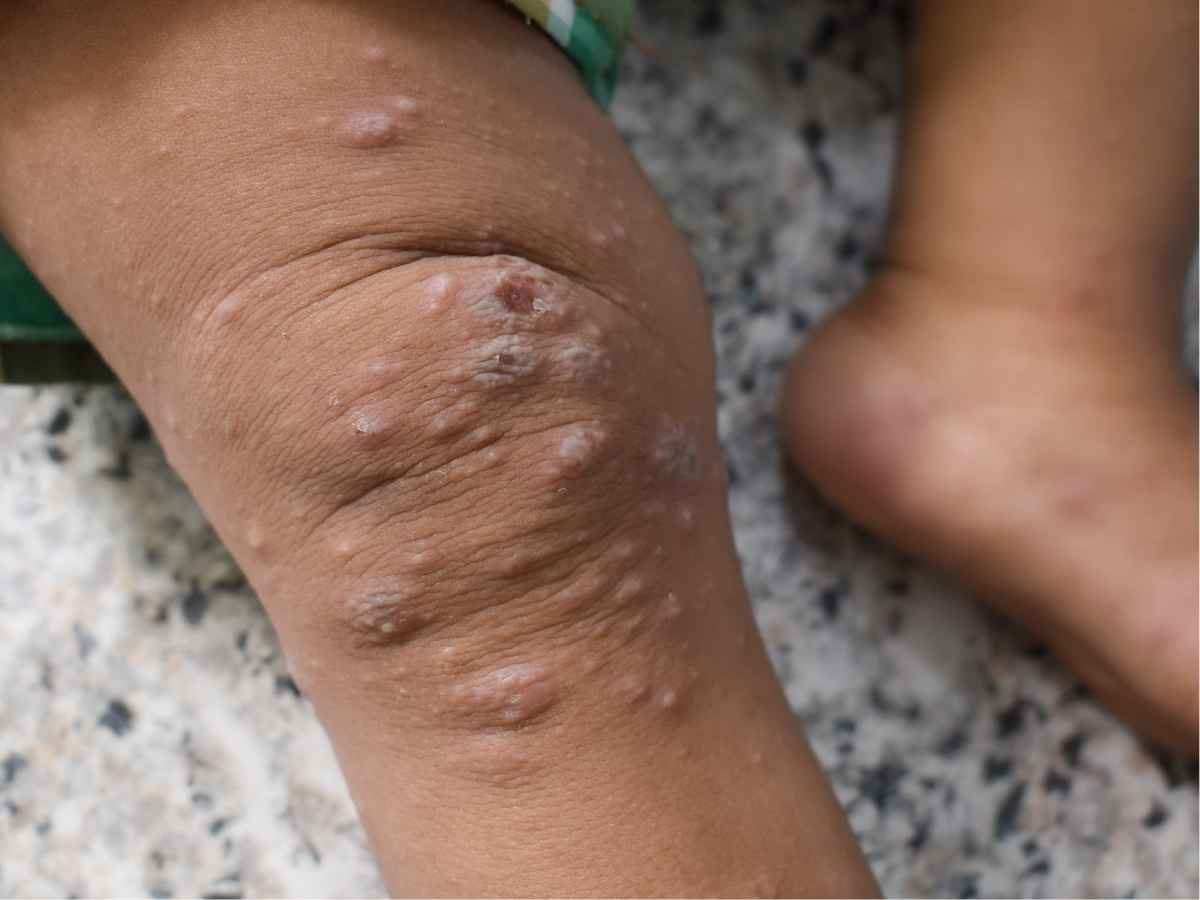 La malattia del vaiolo delle scimmie sulle gambe