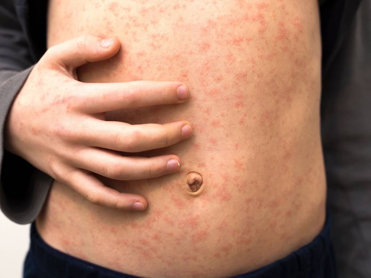 Allarme morbillo, l’Iss: “Da inizio 2025, 432 casi. L’87% non aveva il vaccino”