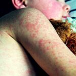 La recrudescenza del morbillo