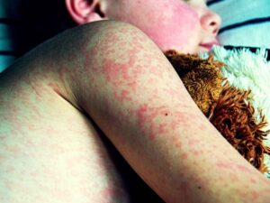La recrudescenza del morbillo