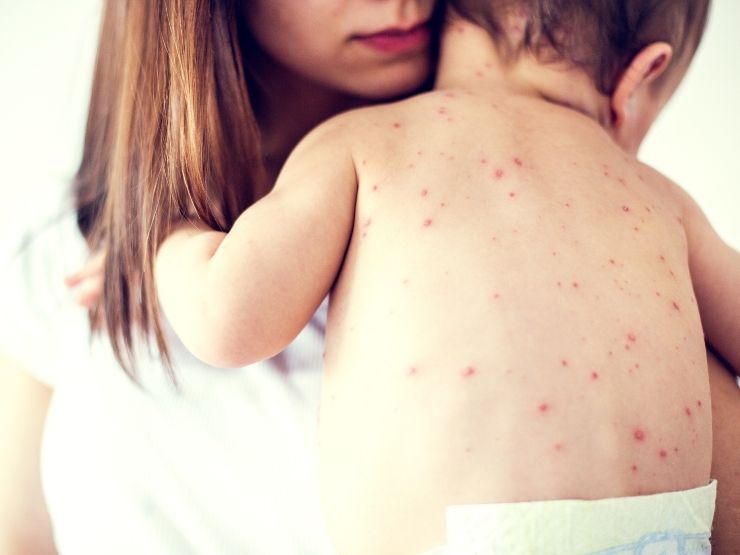 Recrudescenza del morbillo