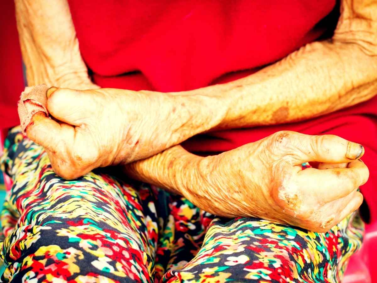 Paziente colpito da lebbra