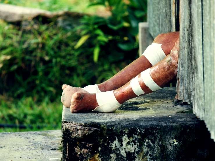 Paziente colpito lebbra