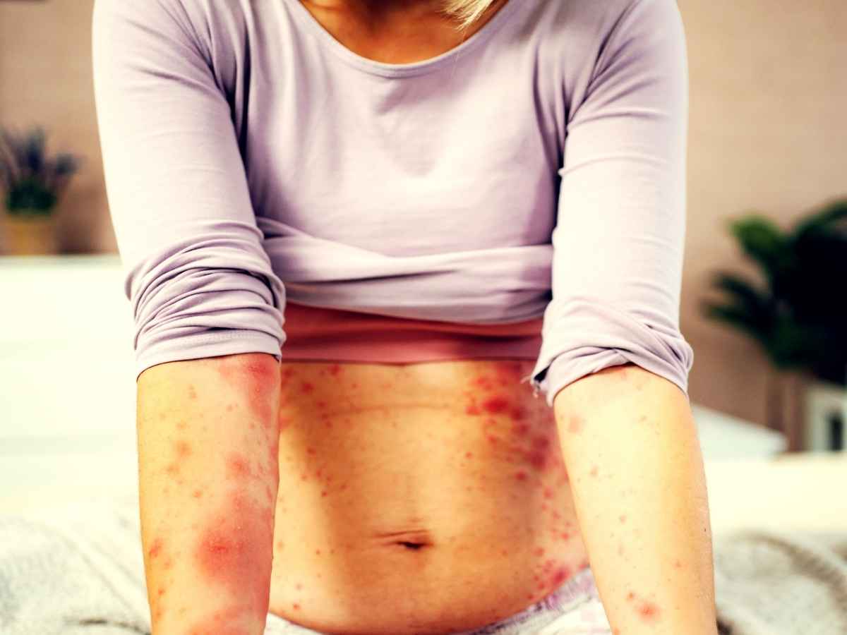 Persona colpita da morbillo