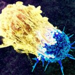 Cancro al pancreas
