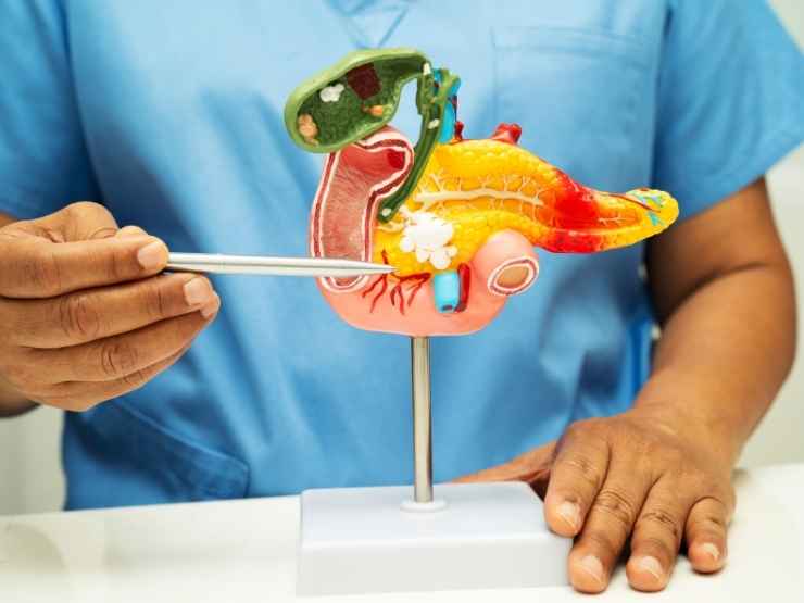 Cancro pancreas
