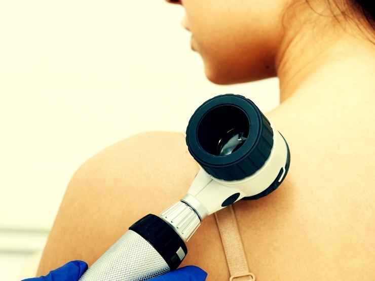 Sudio sul melanoma